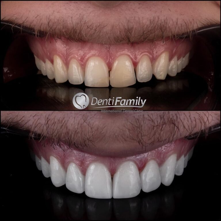 Smile+Design++#diseñodesonrisa+#diseñodesonrisacolombia+#diseñodesonrisabucaramanga+#carillasdentales+#carillasdeporcelana+#carillasderesina+#carillasdentalescolombia+#carillasdentalesbucaramanga+#veneers_smile+#ve