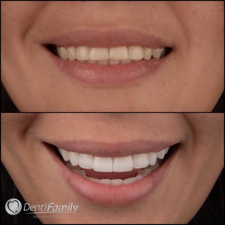 The+Power+Of+Cosmetic+Dentistry++#veneers_smile+#veneers+#carillasdentales+#carillasdeporcelana+#carillasdeporcelana+#blanqueamientodental+#implantesdentales+#aclaramientodentalbucaramamga